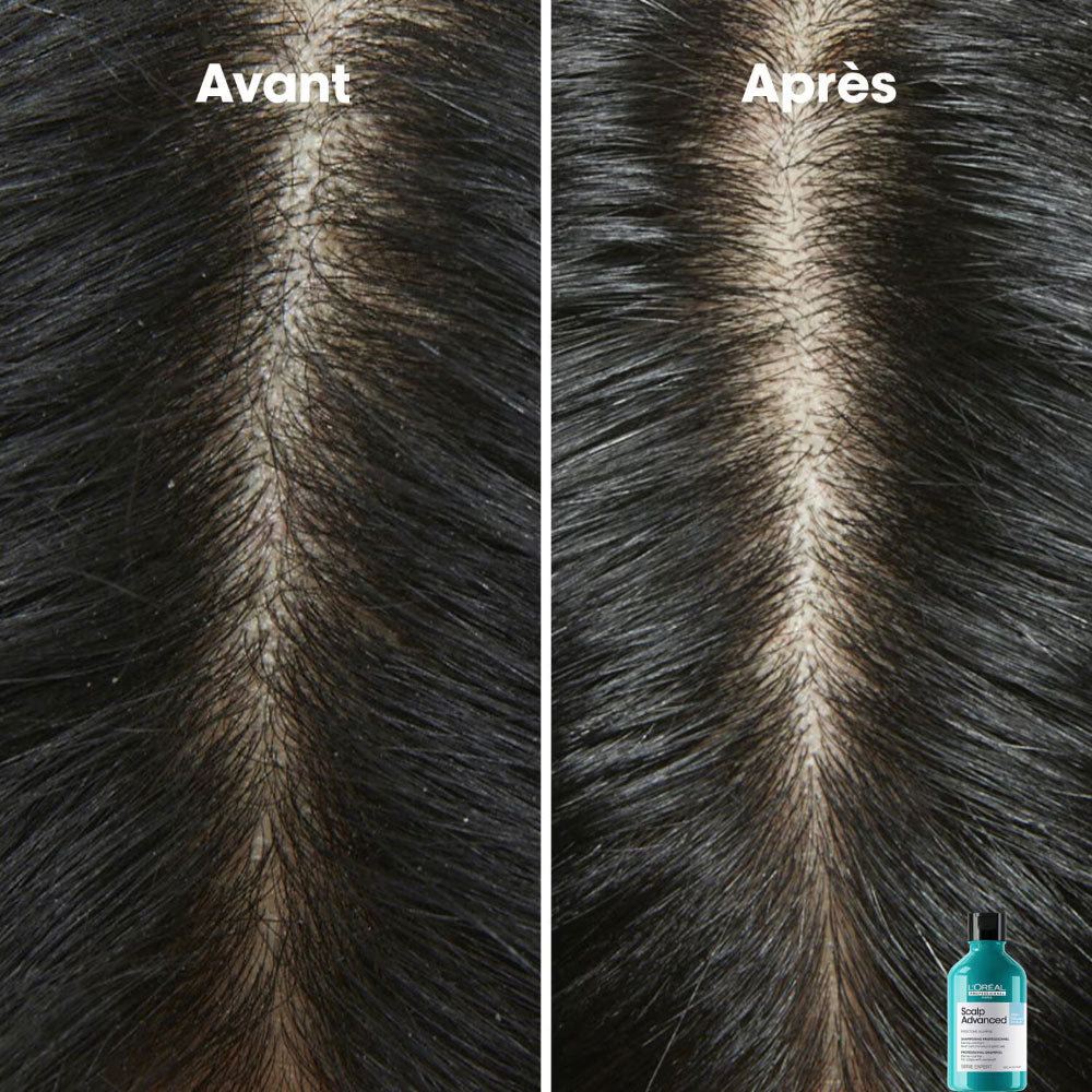 Scalp Advanced Shampoo Anti-Dandruff_3474637109394_L'Oréal Professionnel-2